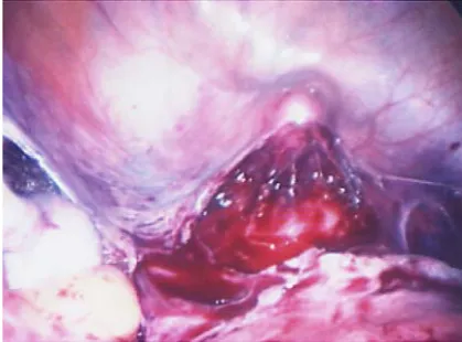 Fig. 2 Bladder dissected off the vagina