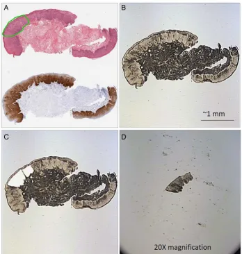 Figure 4Laser capture microdissection of high-grade squamous intraepithelial lesion (HSIL)