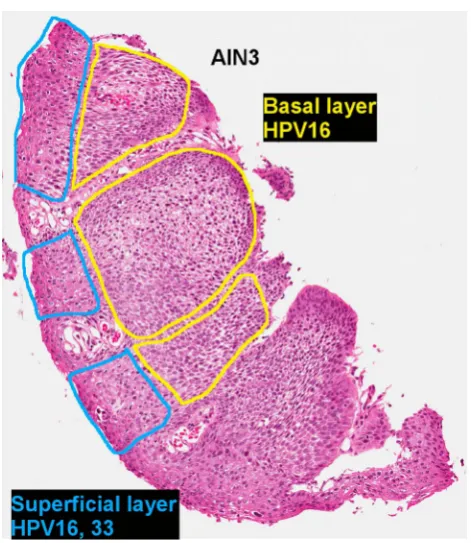 Figure 6Example of a biopsy containing colliding lesionseach positive for different HPV genotypes
