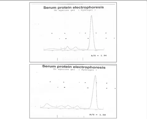 Figure 2 a: Densitometry tracing of gel electrophoresis of normal serum. b: Densitometric tracing of gel electrophoresis of subject withmonoclonal band.