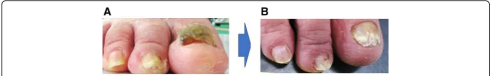 Fig. 5 Change in the toenails of a subject in the intervention group. a Before the intervention