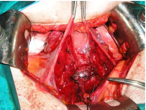 Fig. 3 Ectopic pregnancy excised using a monopolar needle