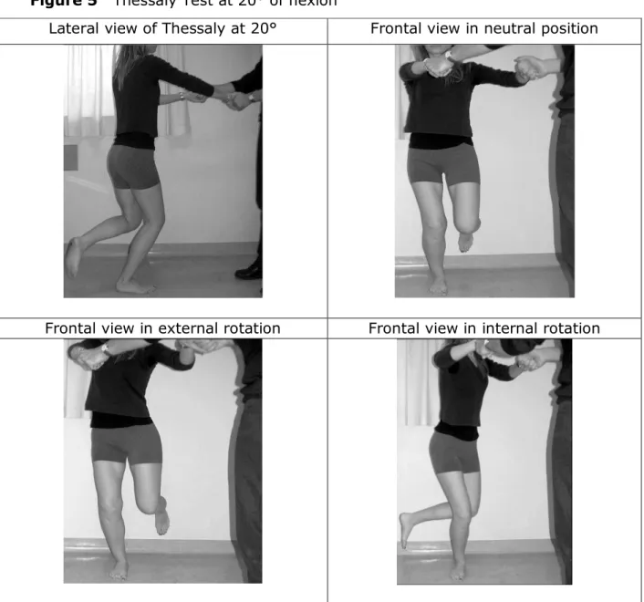 Figure 5   Thessaly Test at 20° of flexion  16