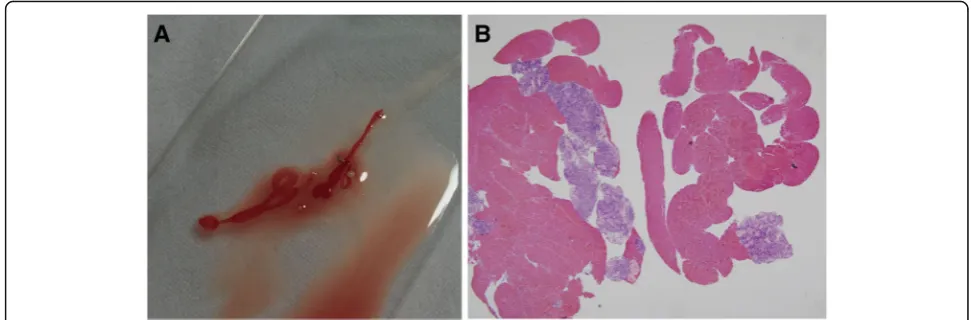 Fig. 1 Macroscopic and microscopic specimens from endoscopic ultrasound-guided fine-needle biopsy with a 20-gauge ProCore needle.findings of the endoscopic ultrasonography-guided fine needle biopsy specimen