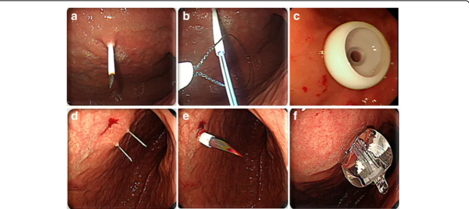 Fig. 2 Percutaneous endoscopic gastrostomy (PEG) using the pull (a–c) or the introducer (d–f) technique