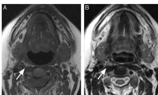 Fig 2. A 52-year-old woman being evaluated with MR imaging for an unrelated indication