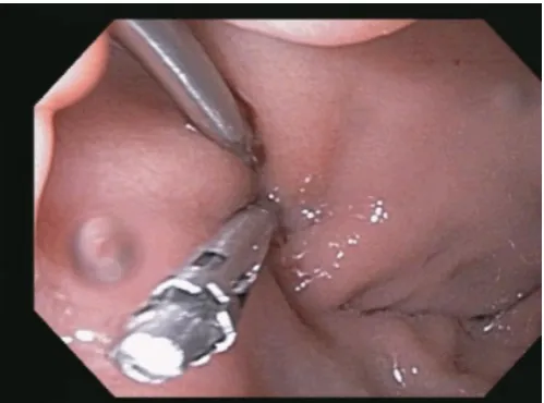 Figure 1: EGD appearance of bleeding source in duodenalbulb.