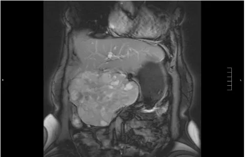 Figure 3: Patient 5 gross specimen demonstrating a well­circumscribed 1.2 cm nodule. Microscopy showed a fibrouscapsule, histologically with mixed solid and cystic componentsconsistent with SPT.