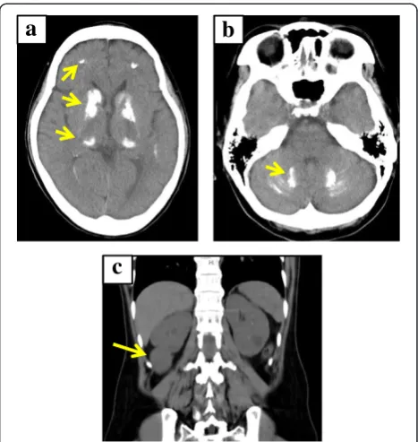 Fig. 1 Plain head and abdominal computed tomography (CT) scansof the proband. a, b. Head CT