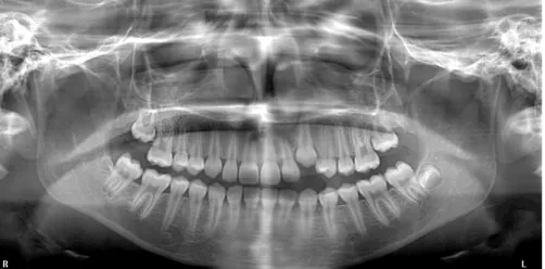 Figure 1: At the beginning of the fixed orthodontic treatment.