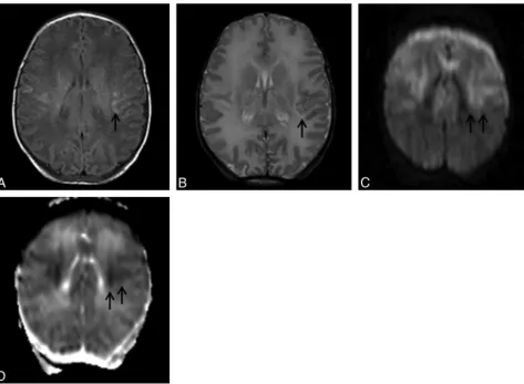Fig 1. ADWI (, T1-weighted image: TR/TE, 550/14 ms; signals acquired, 2; matrix, 205/256; section thickness, 5 mm; section gap, 0.5 mm; FOV, 16 cm
