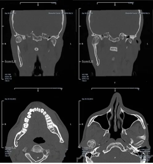 Figure 6: Postoperative panoramic radiography after two years showing the excised condyle and condylar remodeling.