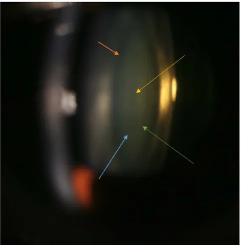 Figure 1.  Macrophotography of the eye-lens in a live patient. The first nucleus that appears during gestation is embryonic nucleus (yellow arrow), followed by fetal nucleus (green arrow) forming an envelope around the previous one