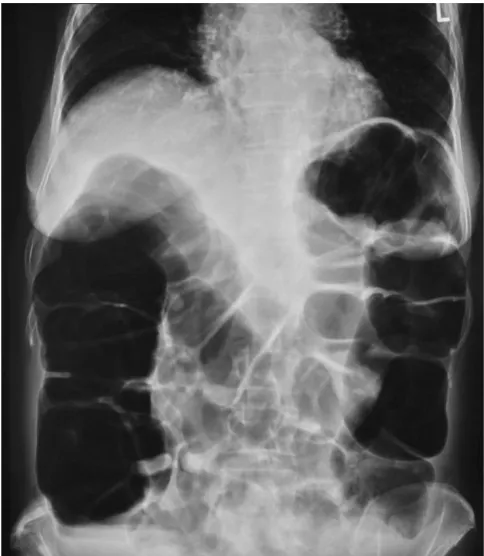 Figure 1Abdominal X-ray of patient 1 at first presentationAbdominal X-ray of patient 1 at first presentation