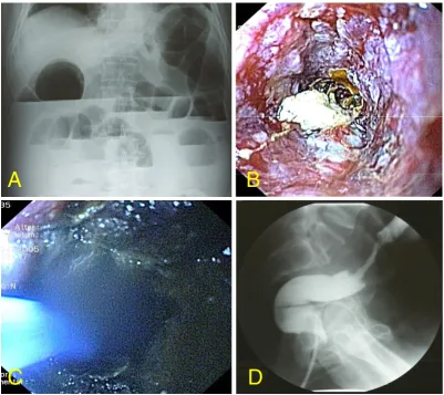 Figure 3Abdominal X-ray of patient 2 at the time of first presentation showing complete colon obstruction and dilatation (A)scopic view of the sigmoid tumor with complete obstruction (B)
