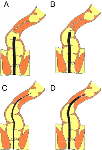 Figure 4Schematic presentation of first-step endoscopic tumor debulkingvia the ERCP catheter and the wire