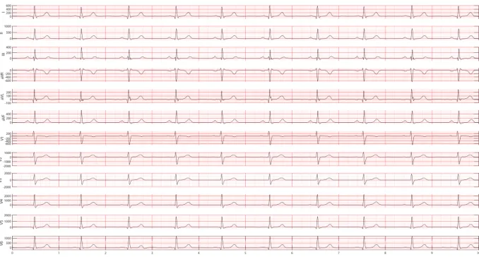 Figure 13.  A 12-lead ECG depicted sinus bradycardia rhythm. Sinus bradycardia can be defined as a sinus  rhythm with a resting heart rate of 60 beats per minute or less.