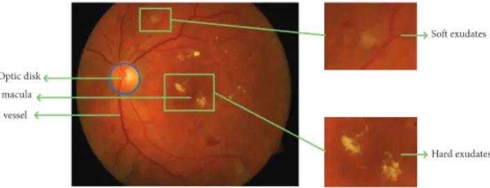 Figure 1: Example of retinal fundus image with exudates regions (zoom into the soft exudates region and hard exudates region).