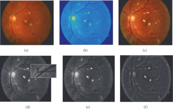 Figure 3: Example of retinal fundus image preprocessing. (a) Original retinal image. (b) Color normalized YIQ plane image