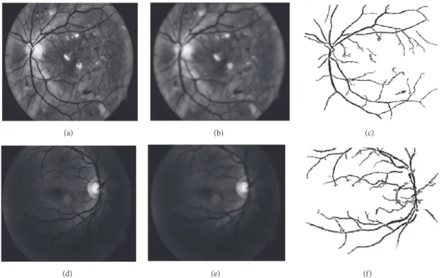Figure 4: Examples of retinal blood vessels extraction on two retinal images with different illumination conditions