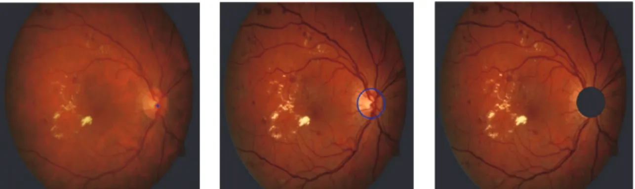 Figure 6: Demonstration of optic disc (OD) localization, segmentation, and masking. (a) Localization of OD center