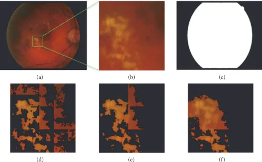 Figure 7: FCM clustering segmentation with different subimage sizes. (a) Original retinal image