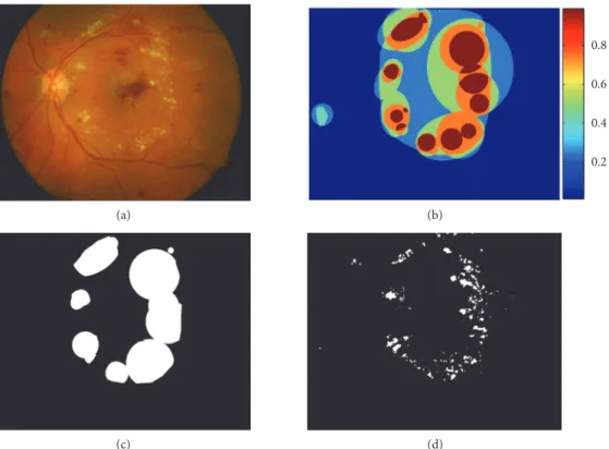 Figure 9: Example of one retinal image in DIARETDB1 database. (a) Original image. (b) Exudates regions labelled by four specialists (color decodes the ground truth confidence)