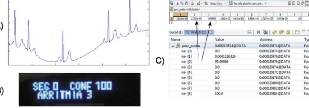 Fig. 11. Numerical result comparison for (A) test signal corresponding to ECG record 201, time frame 18:48–18:54