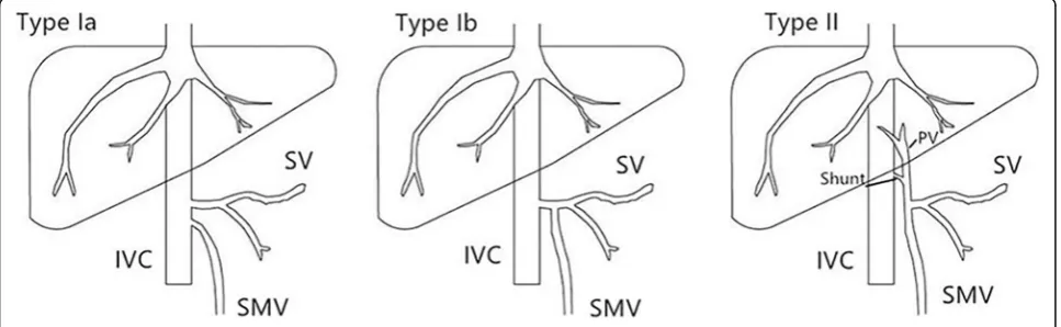 Fig. 1 Classification of Abernethy Malformation