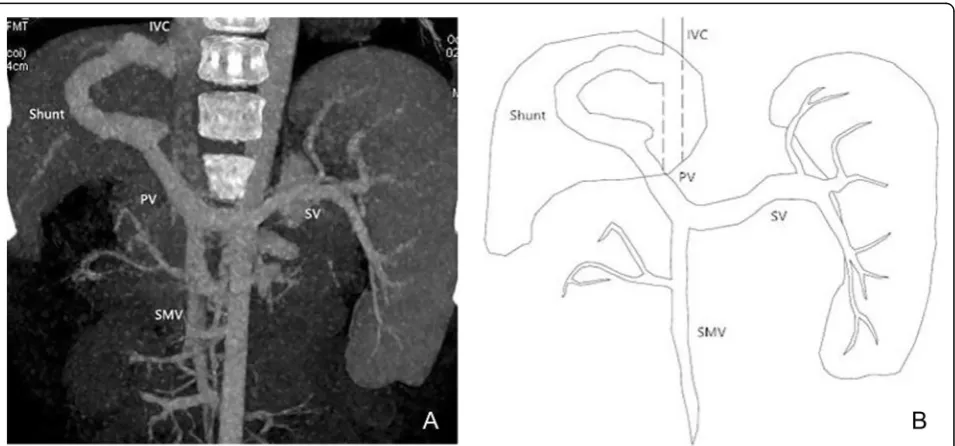 Table 1 Summary of findings in patients with Abernethy Malformation