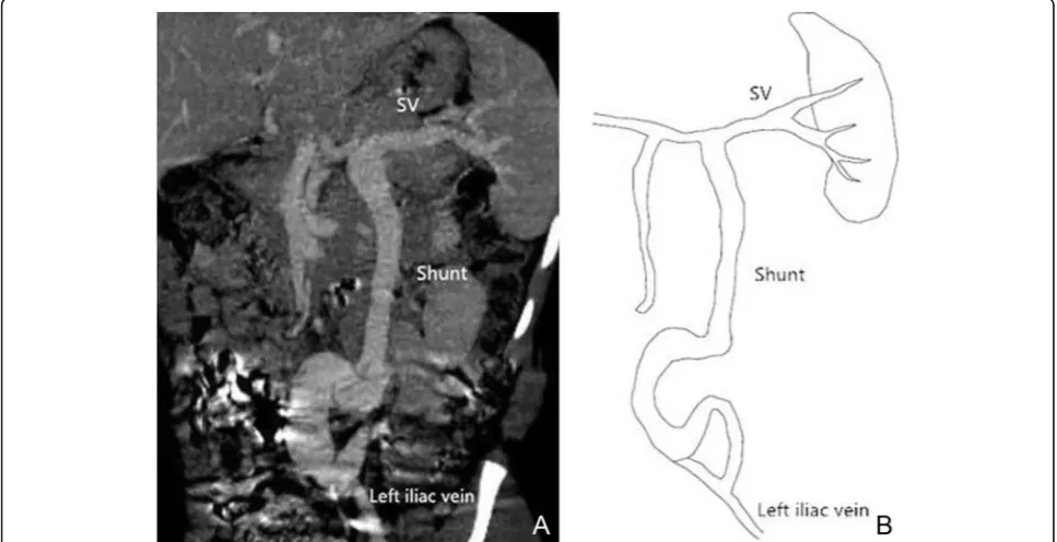Table 2 Accuracy of Classification of Abernethy malformation inMSCT Compared with DSA