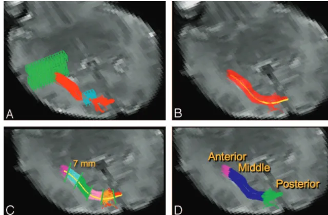 Fig 1. DTI fiber tracking and segmentation.Fiber tracks were filtered with a second region of interest (coordinates from each of the delineated optic radiation fiber tracks (assigned to the closest segment