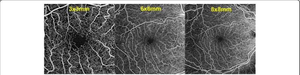 Fig. 2 Examples of OCTA image datasets collected for each individual patient and eye included in the study (3 × 3, 6 × 6 and 8 × 8 mm scansizes, Angioplex, Cirrus HD-OCT, Carl Zeiss Meditec, Dublin, CA, USA)