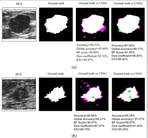 Figure 7nign and a malignant lesion, respectively, obtained froma and b show a quantitative analysis of a be-dataset A