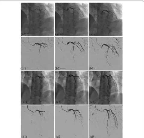 Fig. 2 An example of extracted vascular images by the proposed method. (a1)-(a3), (c1)-(c3) original XRA images in two different sequences, (b1)-(b3), (d1)-(d3) extracted vascular images by IFC-RPCA method