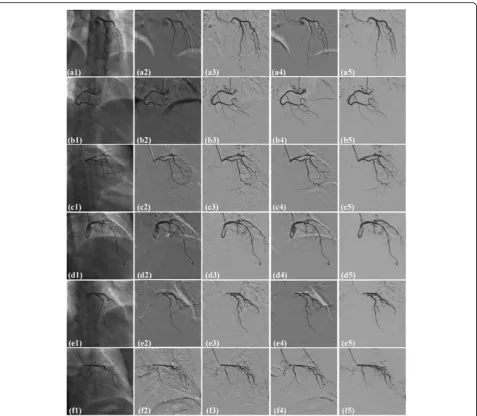 Table 1 Comparison of local and global CNR by four differentmethods, including MER, ORPCA, MCR-RPCA and IFC-RPCA over22 XRA images