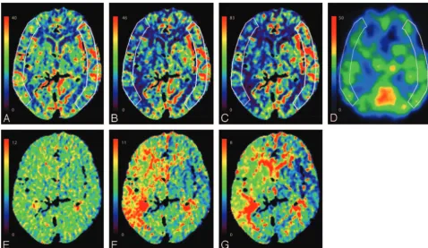 Fig 1. CBF and MTT maps of a 70-year-old woman with occlusion of the right MCA.(deconvolution algorithms.with A and E, CTP with bSVD