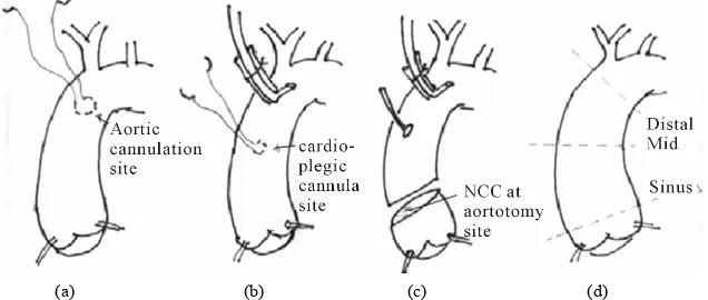 Figure 1. Schematic presentation of ascending aorta showing three site of aortic biopsy sites used in the study and comparing 