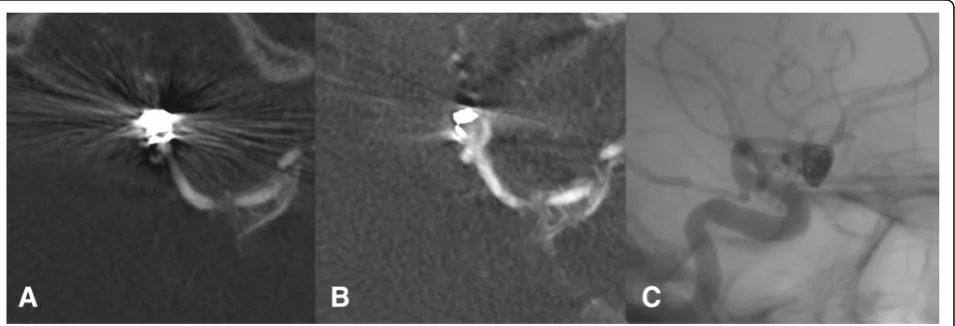 Fig. 3 In image a multiple streak artifacts impair evaluation in the level of implant, whereas in image b after application of MARA the imagequality is improved significantly and the streak artifacts are eliminated
