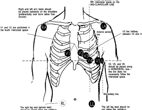 Figure 3. Placement of 12-lead ECG electrodes. RA indicates right arm; LA, left arm; RL, right leg; and LL, left leg.