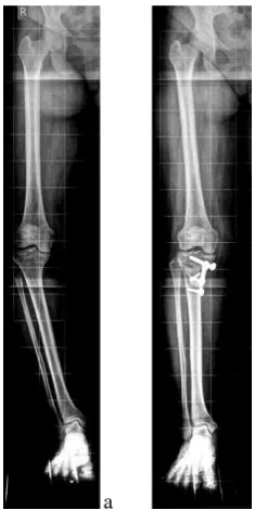 Fig. 9. Full lower limb radiographic images of the patient before and after the operation  