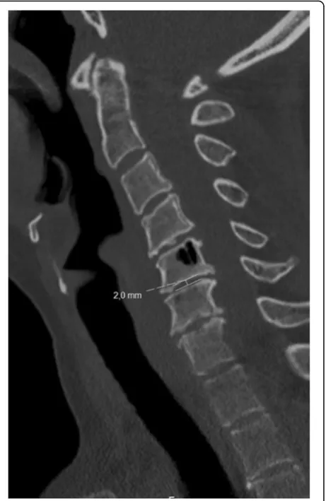 Table 1 Scoring system of cervical disc and facet jointdegeneration. AP = anteroposterior