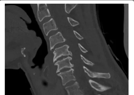 Fig. 3 End plate sclerosis. Definite sclerosis on the end plates at theC5-C6-level resulting in 2 points