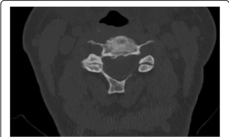 Fig. 4 Facet joint degeneration as exhibited by one of the study patients. To the left, an axial slice through the C5-C6 segment shows joint spacenarrowing, osteophytes and marked irregularities of the right facet joint space leading to 3 points
