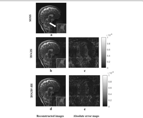 Table 2 NRMSEs of SENSE and HF-SENSE reconstructed imageswith different regularization parameters