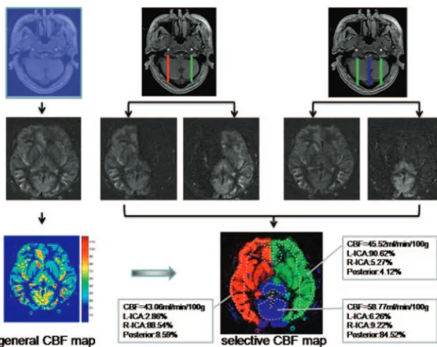 Fig 1. VE processing steps in a volunteer.territories.whole section, in the second image as the right (R) and left (L) ICA, and in the third image as ICAs and posterior circulation