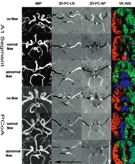 Fig 2. The A1 segment and PcomA flow pattern on MRA and VE-ASL investigations in 6 patients with ICA stenosis