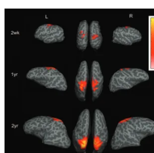 Fig 1. A and B, The anatomic locations for defining thesensorimotor and visual areas are shown, respectively