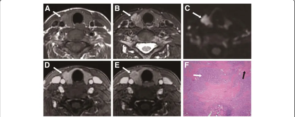 Fig. 2 A 47-year-old woman with thyroid nodular goiter in the left thyroid lobe.nodule (long arrowhead) with patchy hyperintense signal (white arrow) in the left lobe.value of 1.990 × 10 a Axial T1-weighted image showing a heterogeneous isointense b Axial 