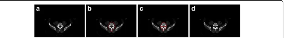 Fig. 2 Four consecutive CT images of Patient 1. (a) and (b) have similar bone topologies